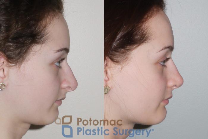 Before & After Rhinoplasty - Medical Case 94 Right Side View in Washington DC & Arlington , DC
