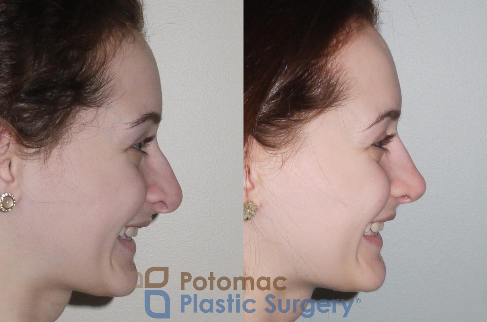 Before & After Rhinoplasty - Cosmetic Case 94 Right Side View #2 View in Washington DC & Arlington , DC