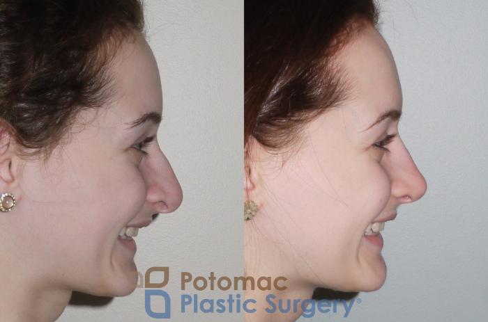 Before & After Rhinoplasty - Medical Case 94 Right Side View #2 View in Washington DC & Arlington , DC