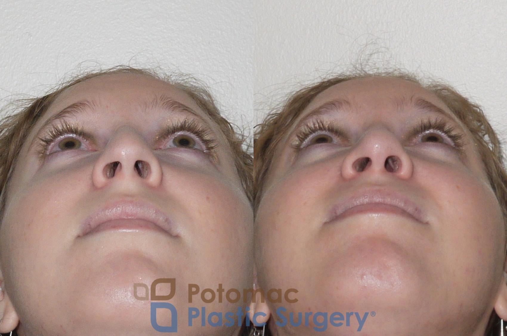 Before & After Rhinoplasty - Cosmetic Case 99 Below View in Washington, DC