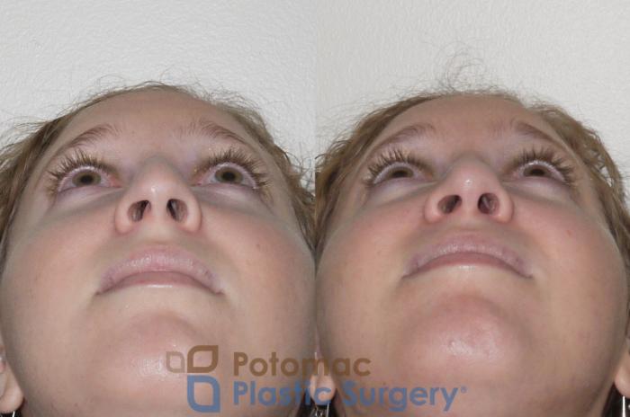 Before & After Rhinoplasty - Medical Case 99 Below View in Washington DC & Arlington , DC