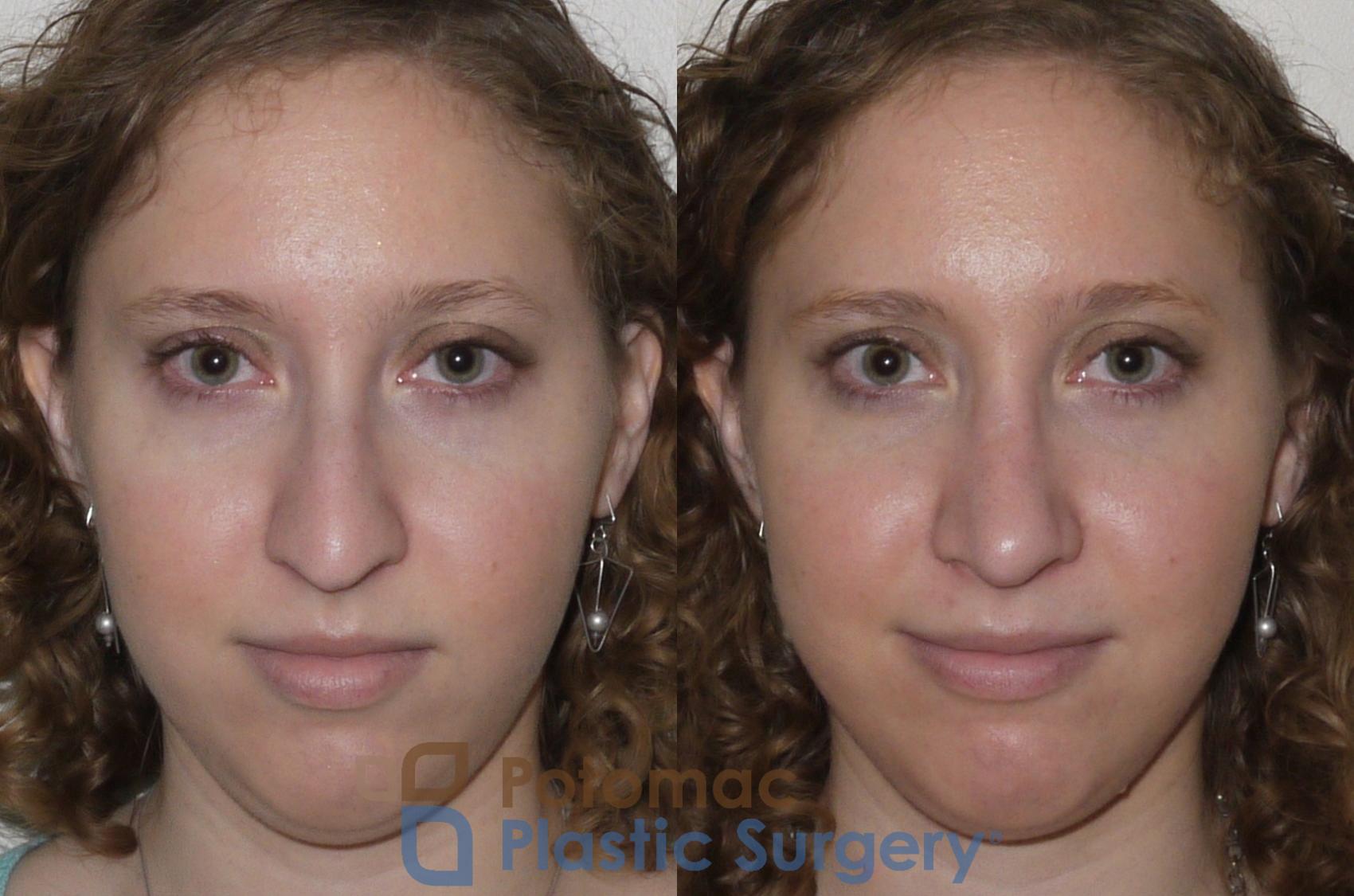 Before & After Rhinoplasty - Cosmetic Case 99 Front View in Washington DC & Arlington , DC