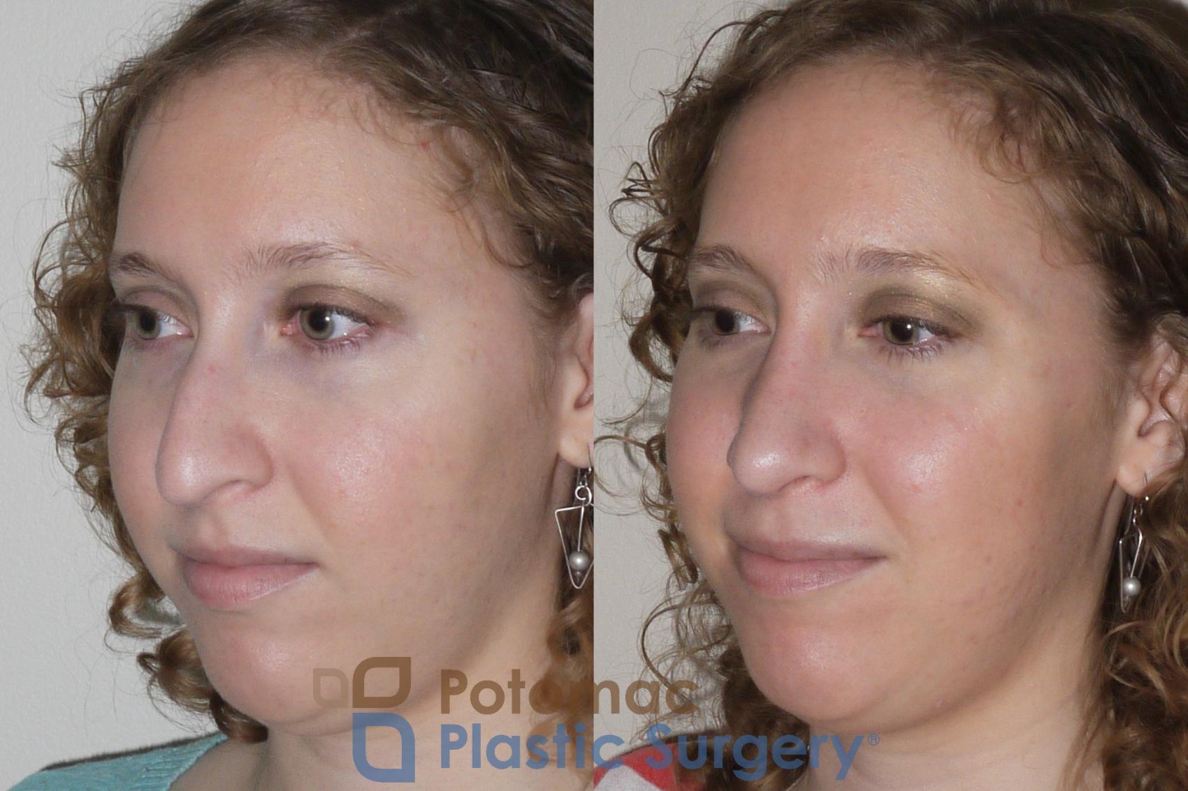 Before & After Rhinoplasty - Cosmetic Case 99 Left Oblique View in Washington, DC