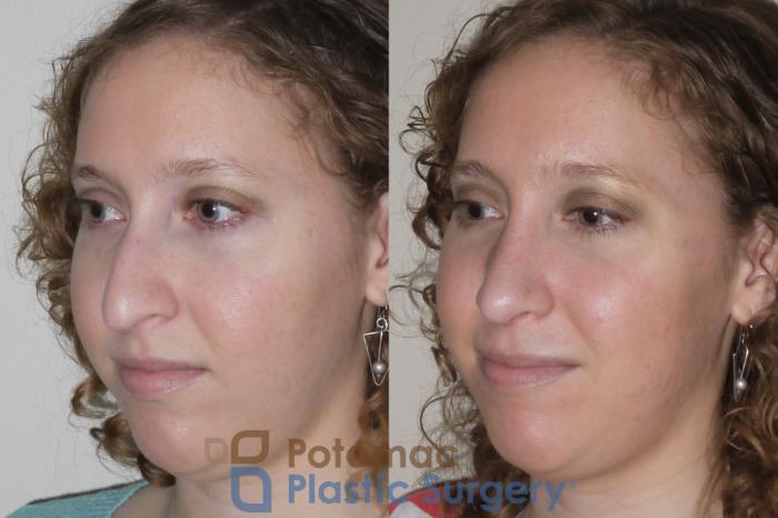 Before & After Rhinoplasty - Medical Case 99 Left Oblique View in Washington DC & Arlington , DC