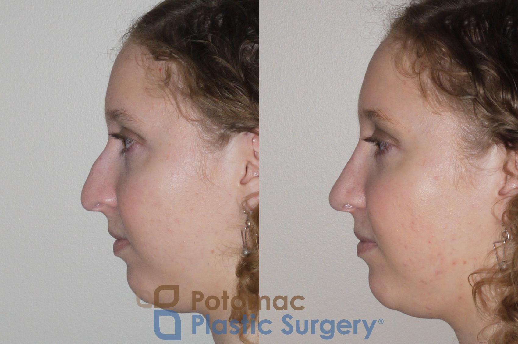 Before & After Rhinoplasty - Cosmetic Case 99 Left Side View in Washington, DC