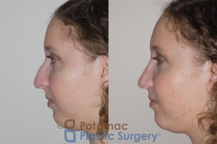 Before & After Rhinoplasty - Medical Case 99 Left Side View in Washington DC & Arlington , DC