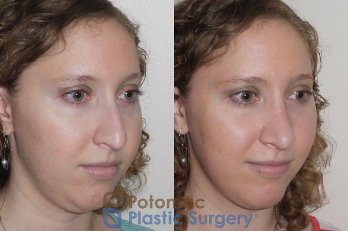 Before & After Rhinoplasty - Medical Case 99 Right Oblique View in Washington DC & Arlington , DC