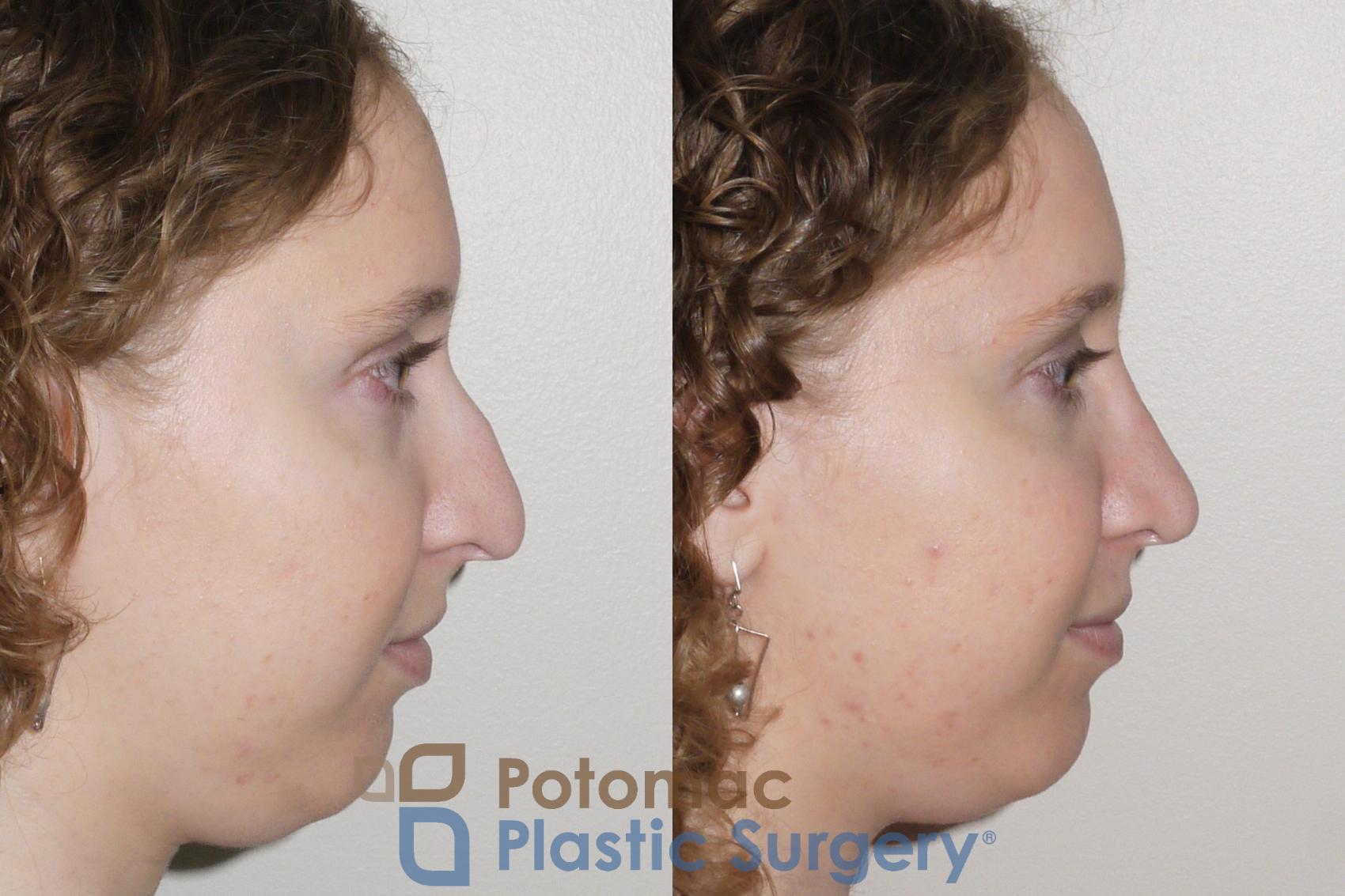Before & After Rhinoplasty - Cosmetic Case 99 Right Side View in Washington, DC