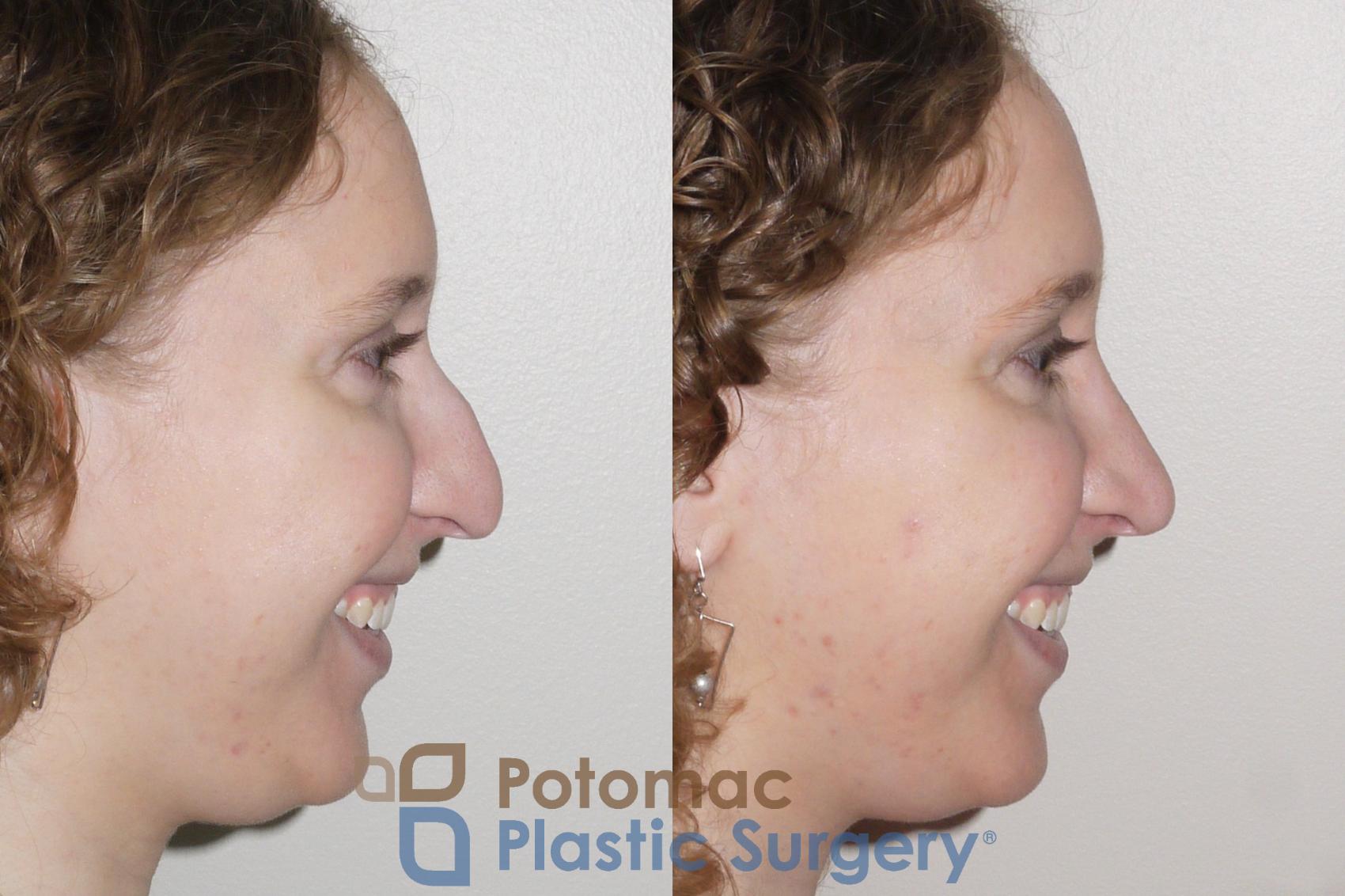 Before & After Rhinoplasty - Cosmetic Case 99 Right Side View #2 View in Washington, DC