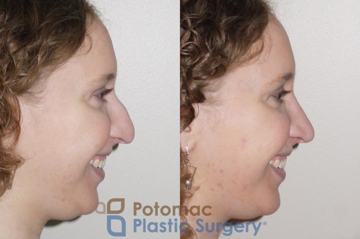 Before & After Rhinoplasty - Medical Case 99 Right Side View #2 View in Washington DC & Arlington , DC