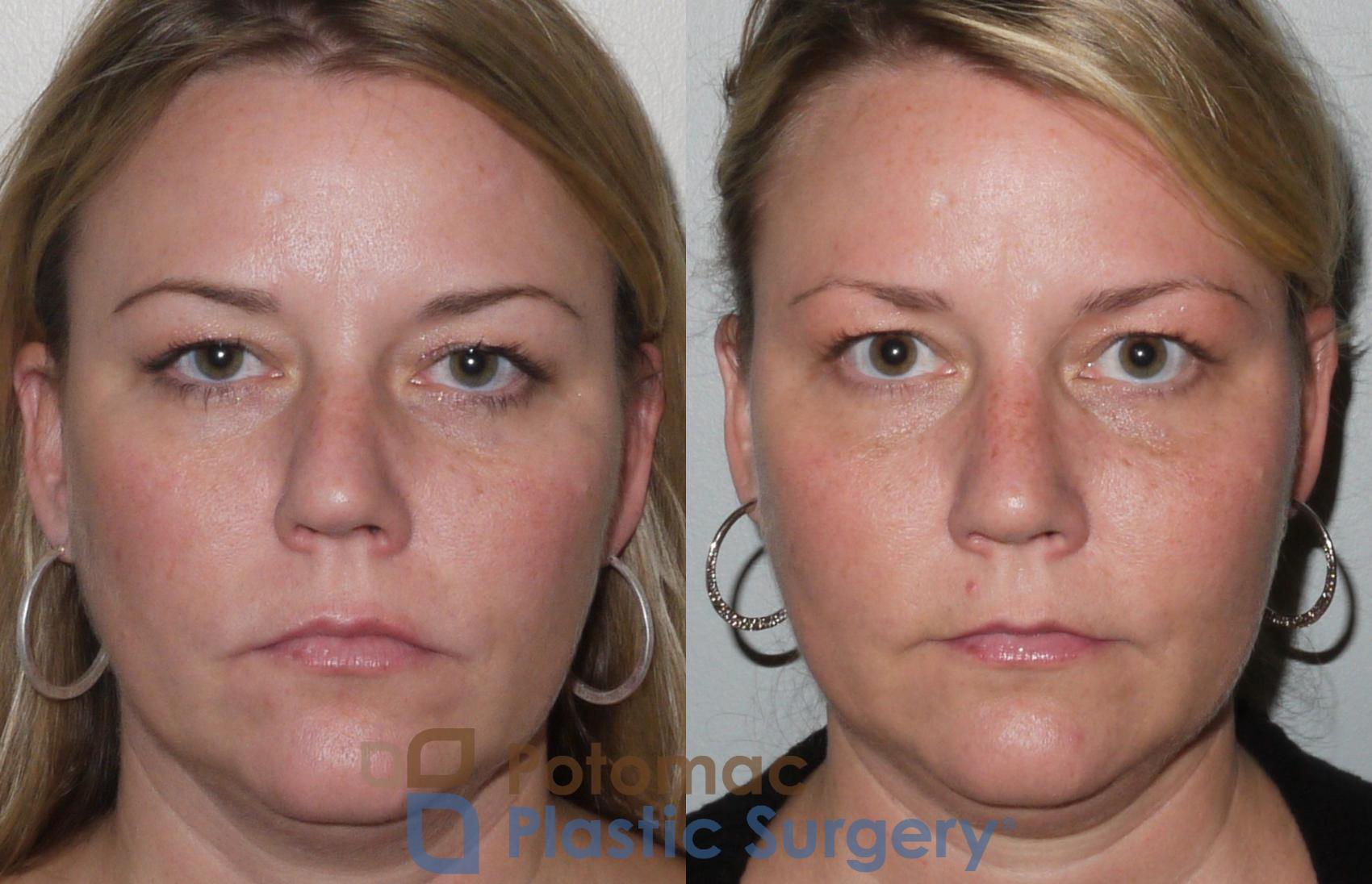 Before & After Rhinoplasty - Cosmetic Case 103 View #2 View in Washington, DC