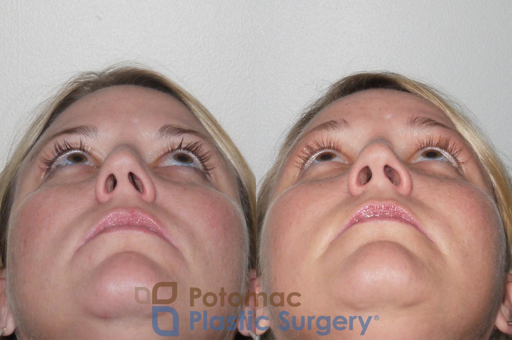 Before & After Rhinoplasty - Medical Case 103 View #3 View in Washington, DC