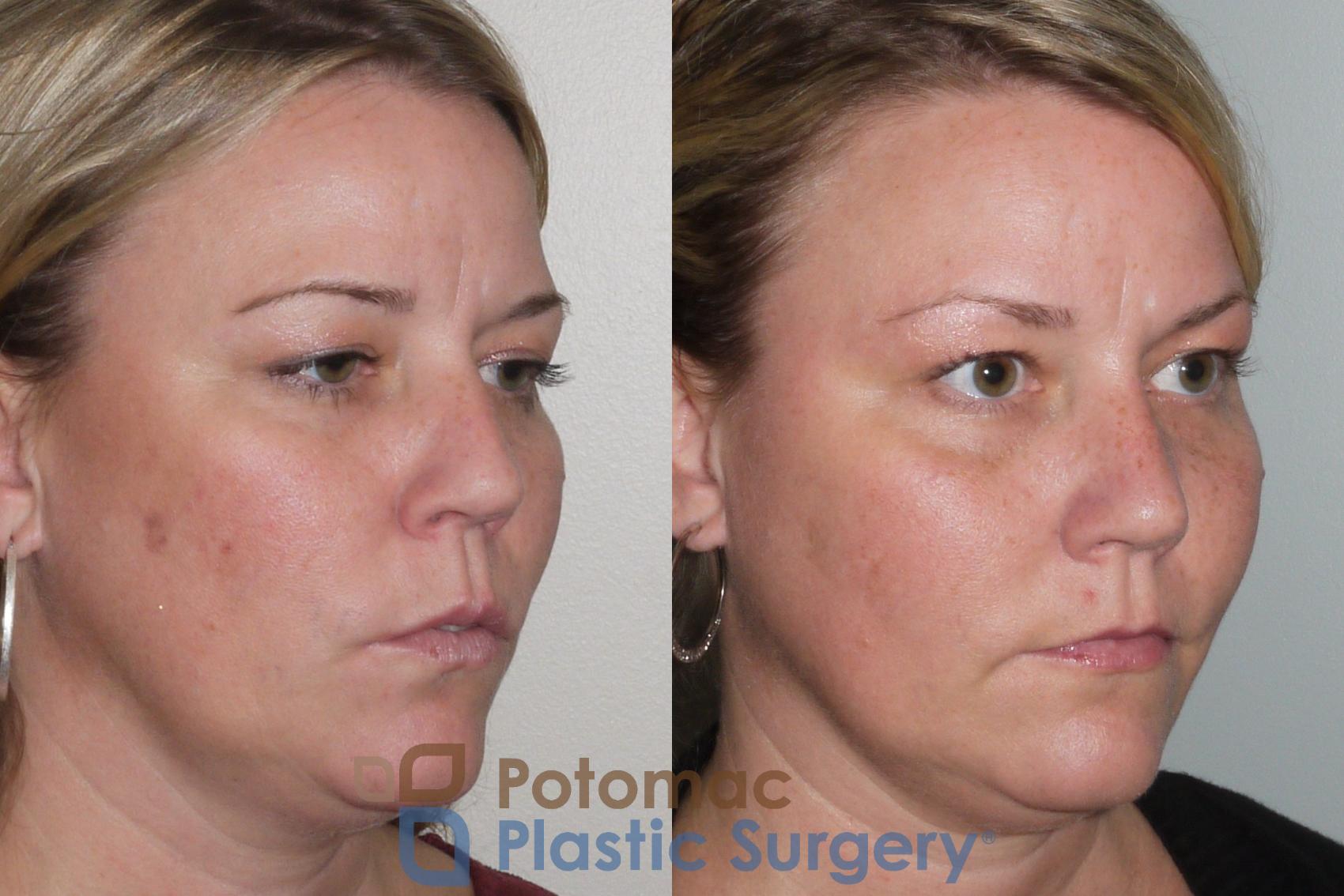Before & After Rhinoplasty - Medical Case 103 View #4 View in Washington, DC
