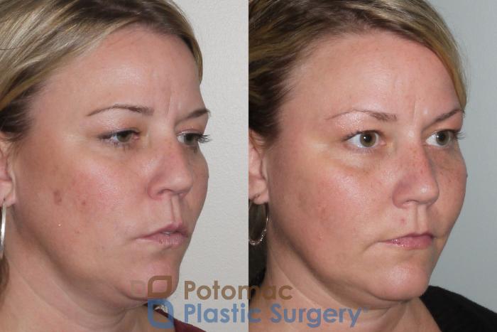 Before & After Rhinoplasty - Cosmetic Case 103 View #4 View in Washington, DC