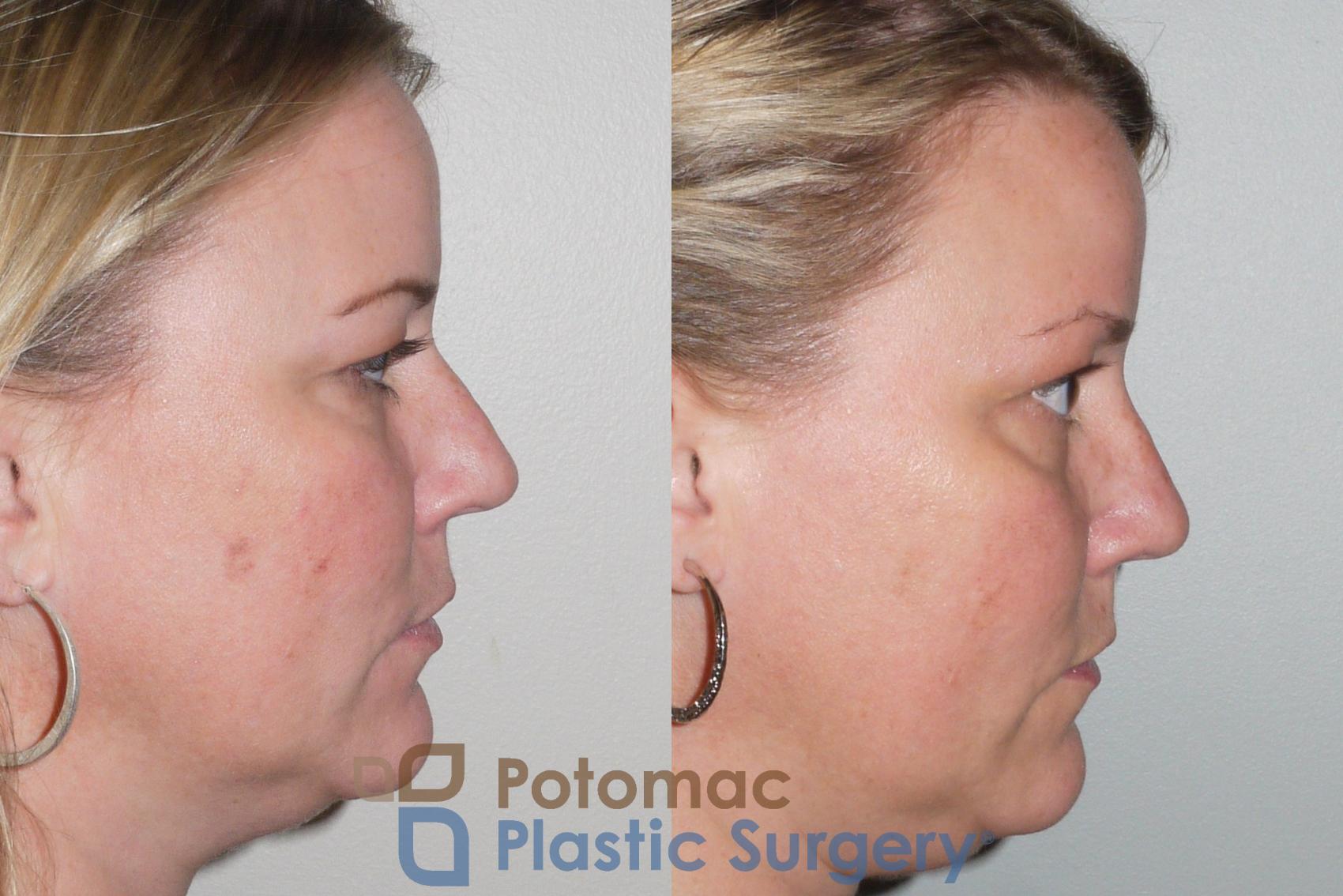 Before & After Rhinoplasty - Medical Case 103 View #5 View in Washington, DC