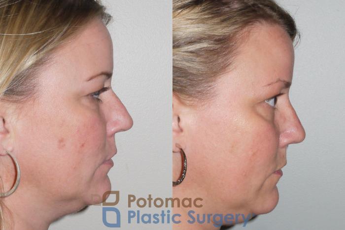 Before & After Rhinoplasty - Cosmetic Case 103 View #5 View in Washington, DC