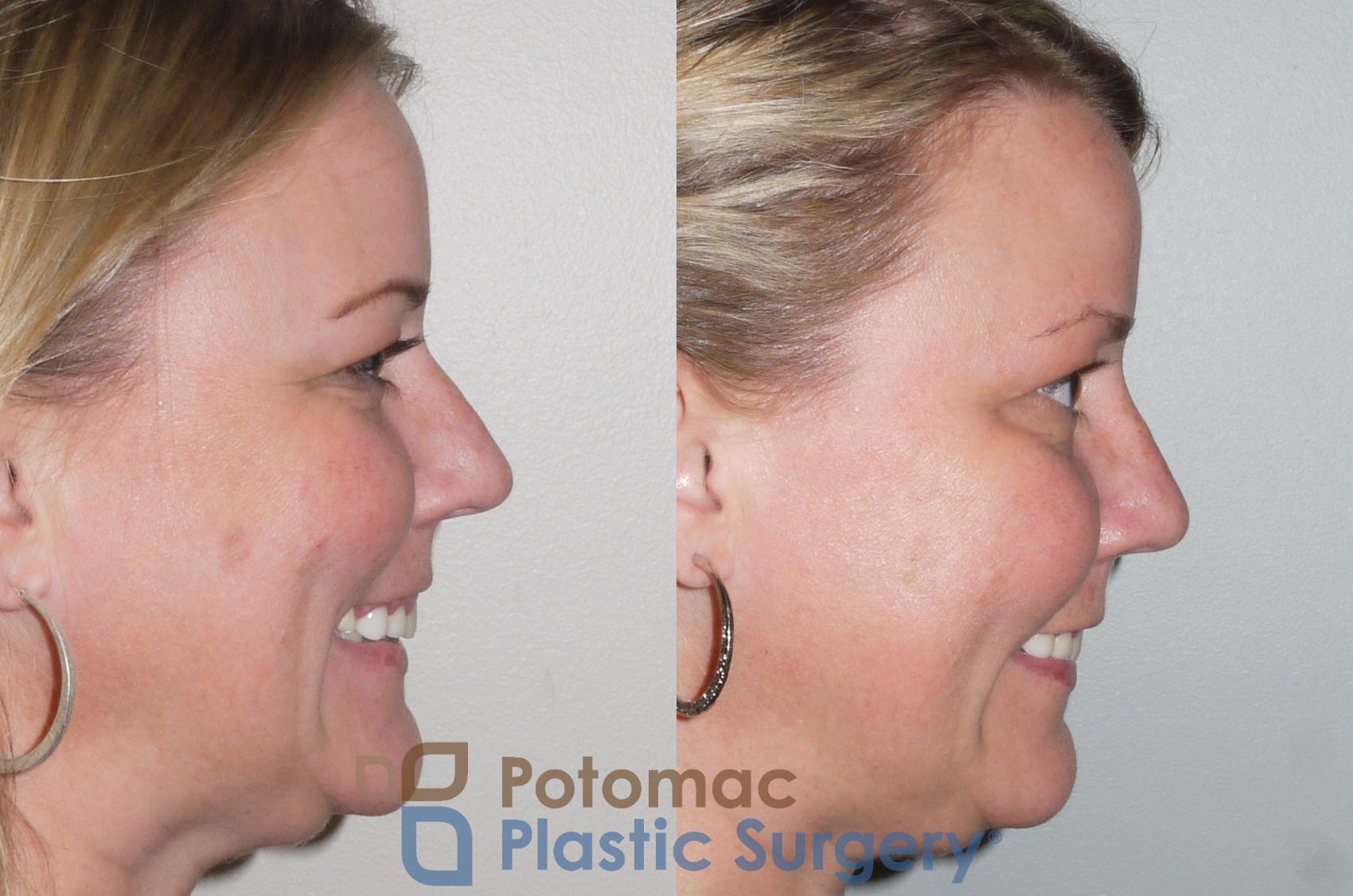 Before & After Rhinoplasty - Cosmetic Case 103 View #6 View in Washington DC & Arlington , DC