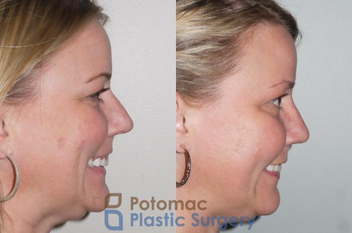 Before & After Rhinoplasty - Cosmetic Case 103 View #6 View in Washington, DC