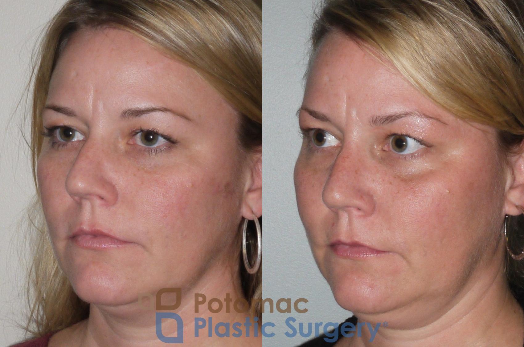 Before & After Rhinoplasty - Medical Case 103 View #7 View in Washington, DC