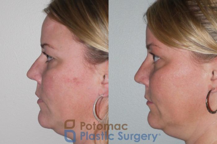 Before & After Rhinoplasty - Cosmetic Case 103 View #8 View in Washington, DC