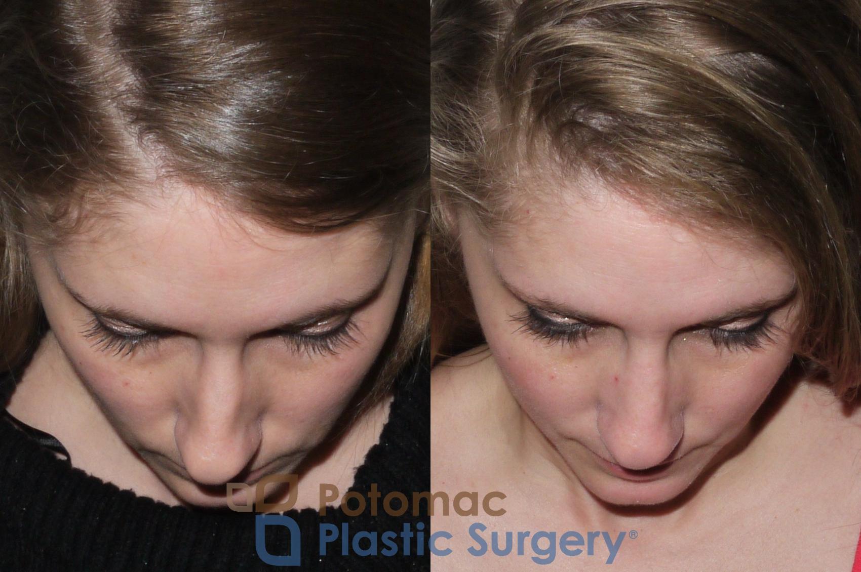 Before & After Rhinoplasty - Medical Case 104 Above View in Washington, DC