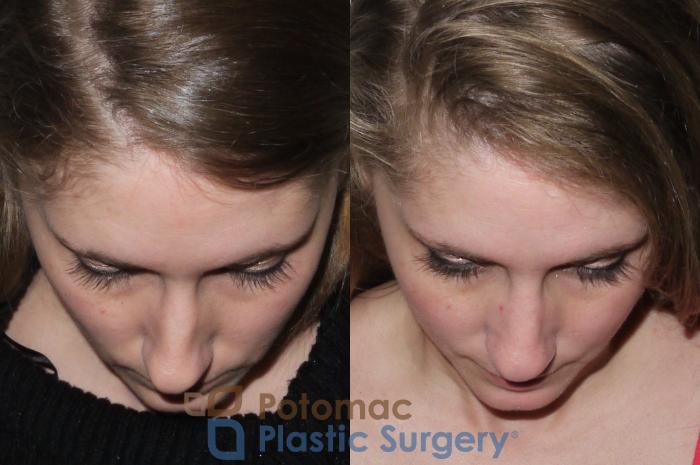 Before & After Rhinoplasty - Medical Case 104 Above View in Washington DC & Arlington , DC