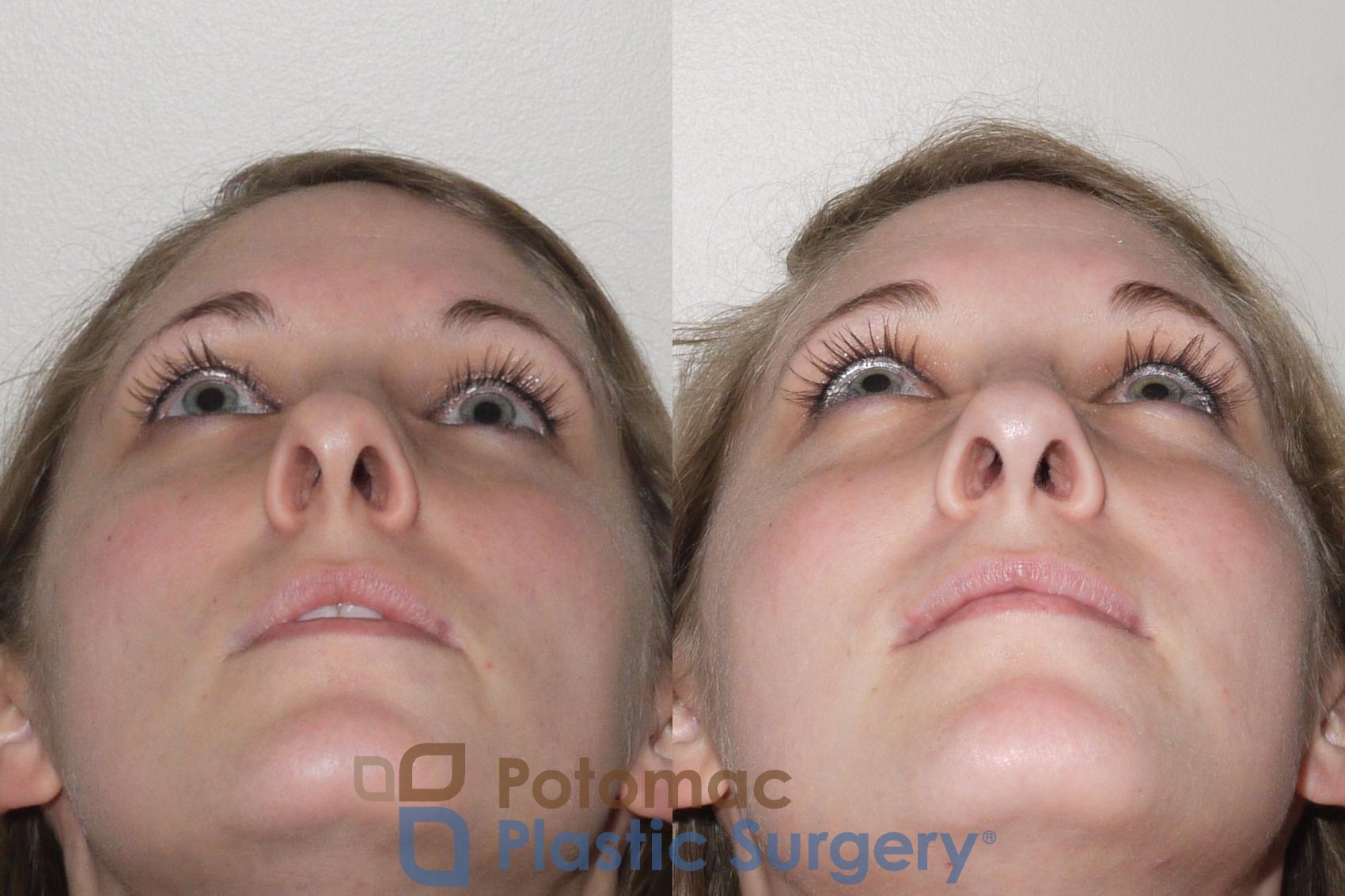 Before & After Rhinoplasty - Medical Case 104 Below View in Washington, DC