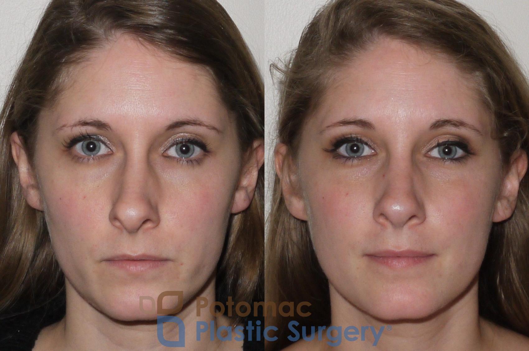 Before & After Rhinoplasty - Medical Case 104 Front View in Washington, DC