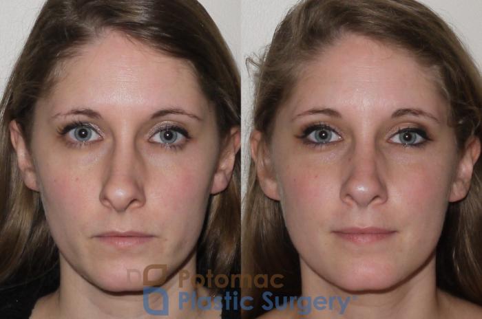 Before & After Rhinoplasty - Medical Case 104 Front View in Washington DC & Arlington , DC