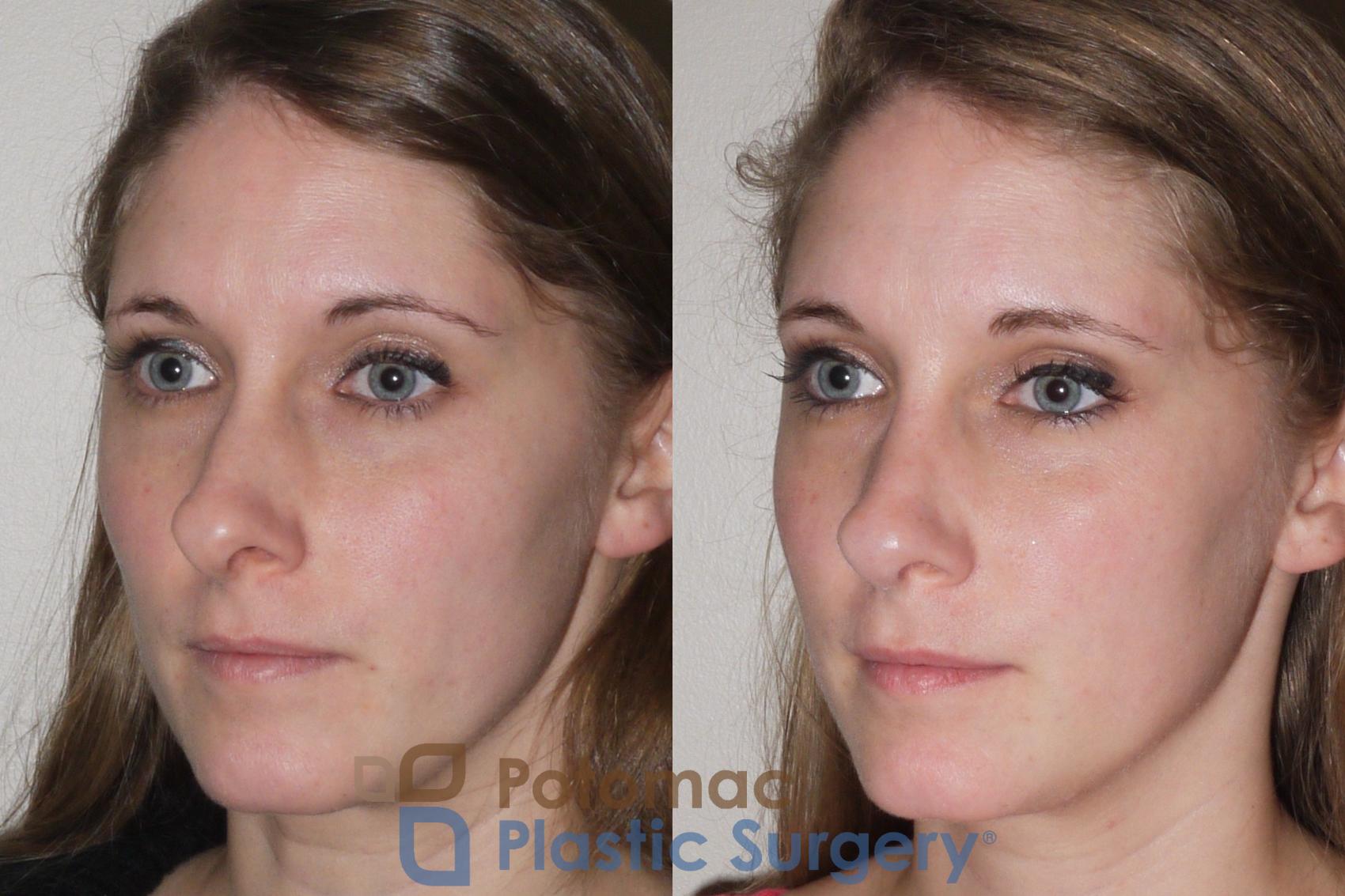 Before & After Rhinoplasty - Medical Case 104 Left Oblique View in Washington, DC