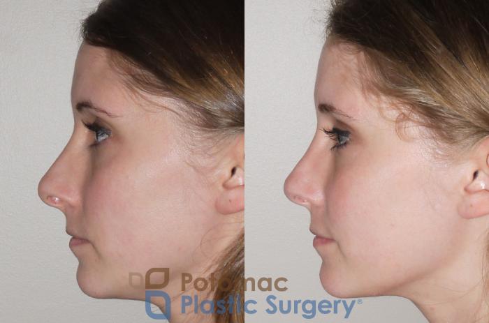 Before & After Rhinoplasty - Cosmetic Case 104 Left Side View in Washington DC & Arlington , DC