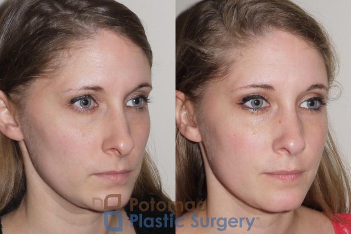 Before & After Rhinoplasty - Medical Case 104 Right Oblique View in Washington DC & Arlington , DC