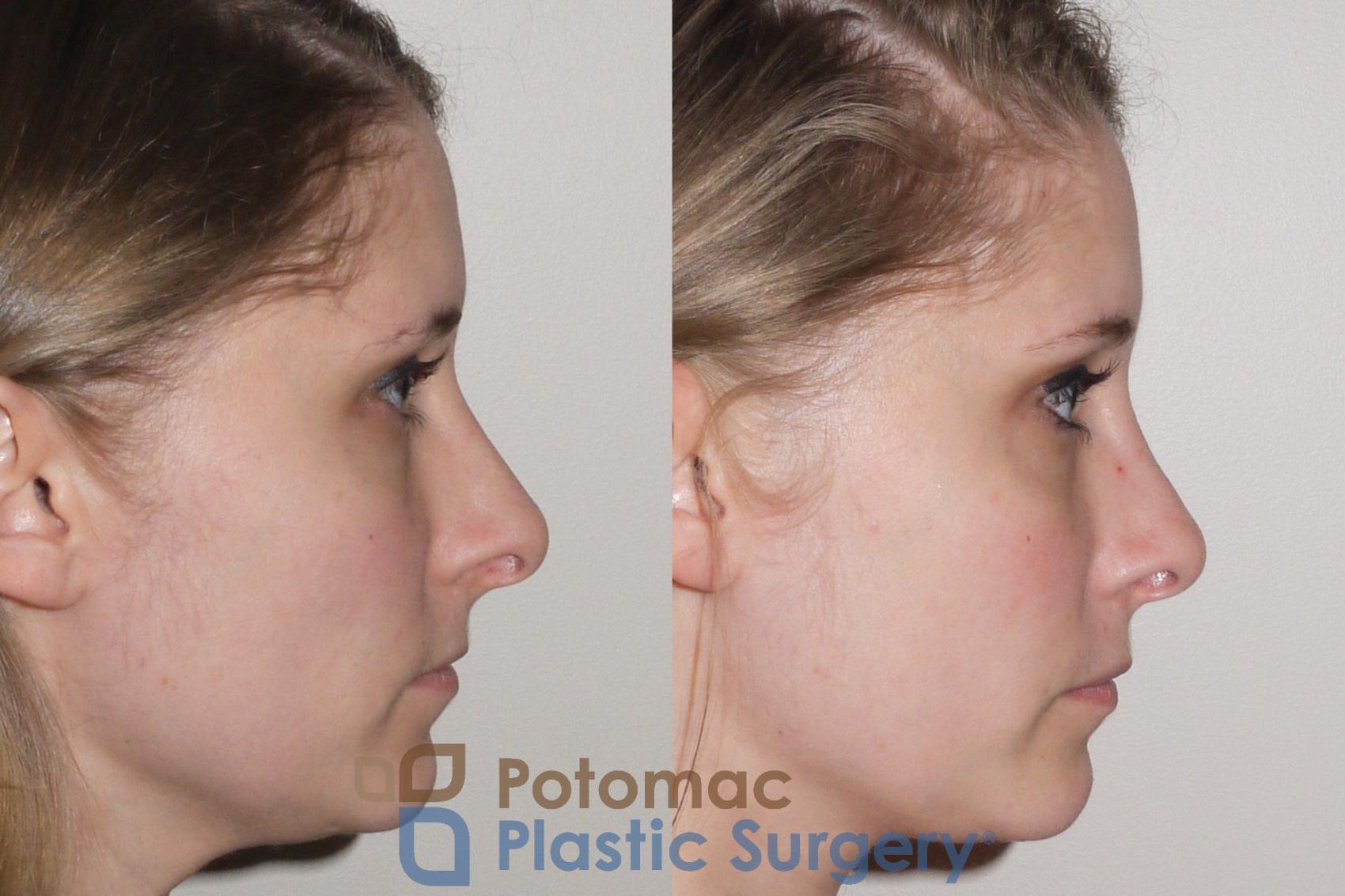 Before & After Rhinoplasty - Medical Case 104 Right Side View in Washington, DC