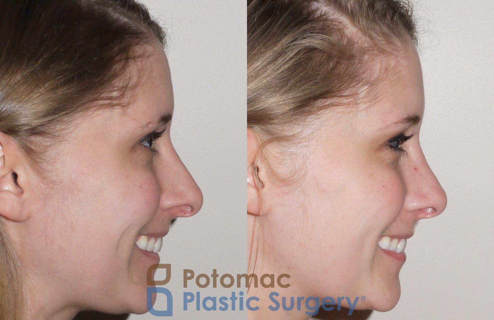 Before & After Rhinoplasty - Medical Case 104 Right Side View #2 View in Washington, DC