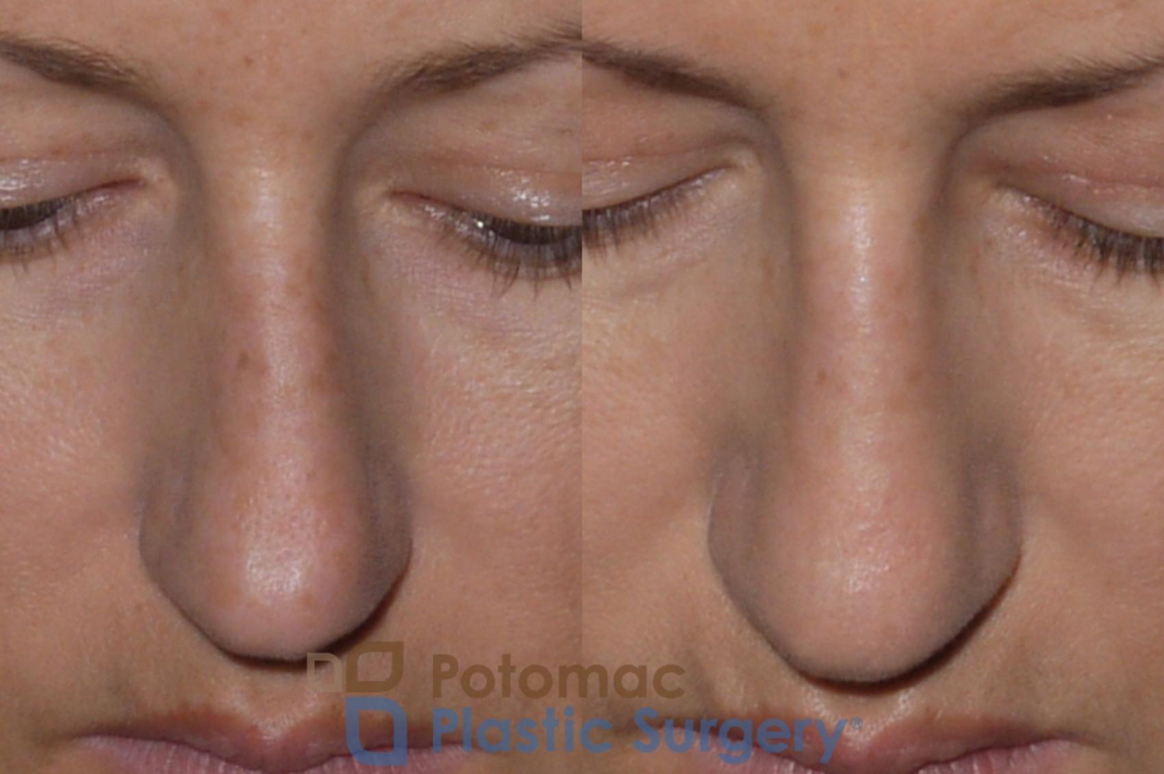 Before & After Rhinoplasty - Medical Case 112 Above View in Washington, DC