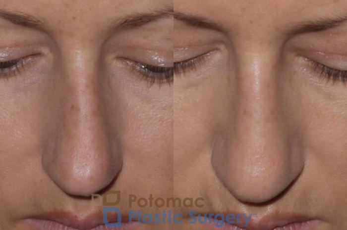 Before & After Rhinoplasty - Cosmetic Case 112 Above View in Washington DC & Arlington , DC