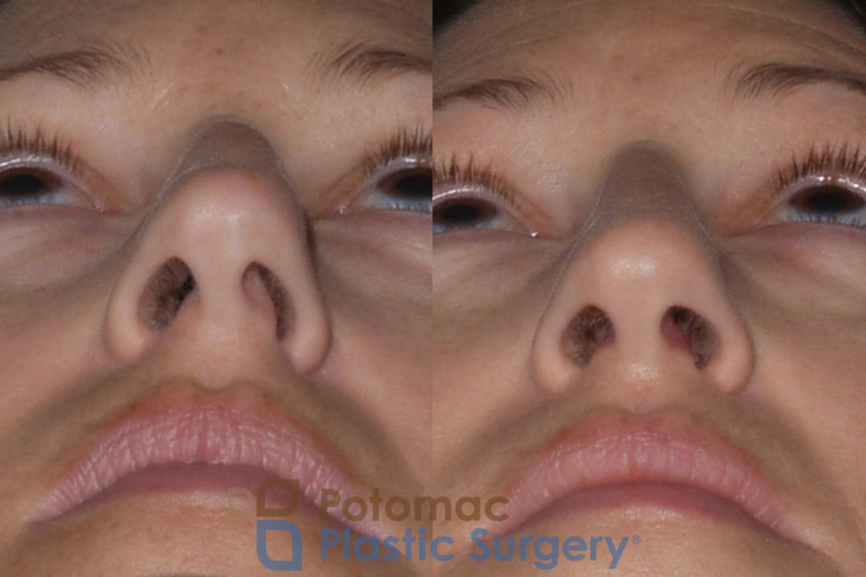 Before & After Rhinoplasty - Medical Case 112 Below View in Washington, DC