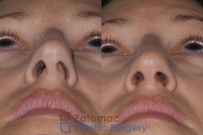 Before & After Rhinoplasty - Medical Case 112 Below View in Washington DC & Arlington , DC