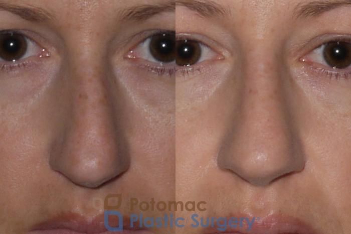 Before & After Rhinoplasty - Cosmetic Case 112 Front View in Washington DC & Arlington , DC