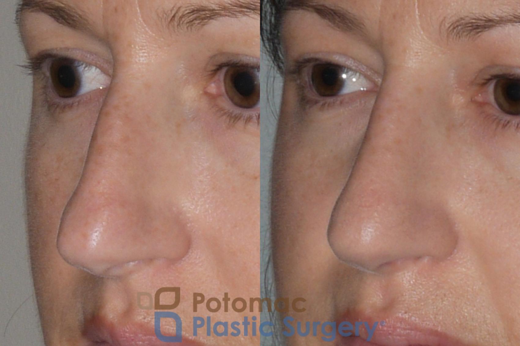 Before & After Rhinoplasty - Medical Case 112 Left Oblique View in Washington, DC