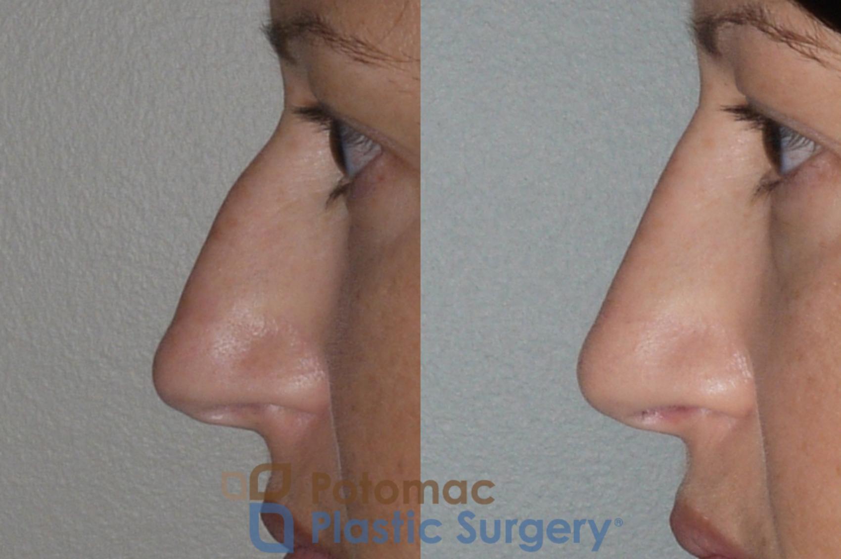 Before & After Rhinoplasty - Medical Case 112 Left Side View in Washington, DC