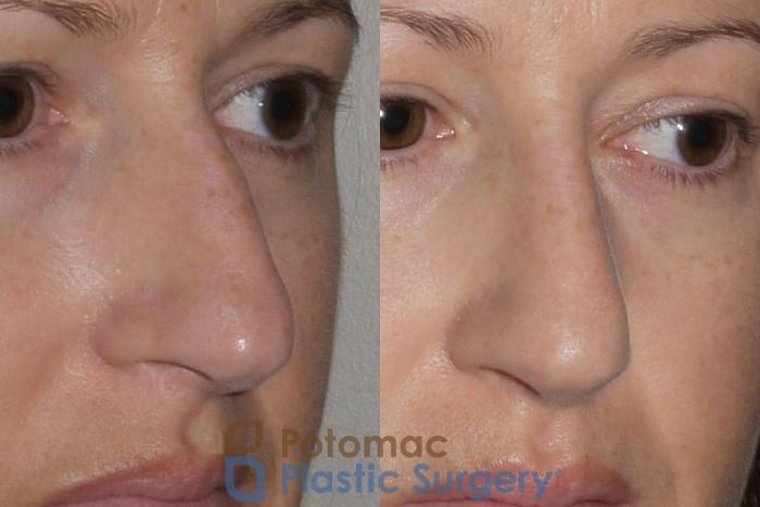 Before & After Rhinoplasty - Cosmetic Case 112 Right Oblique View in Washington DC & Arlington , DC