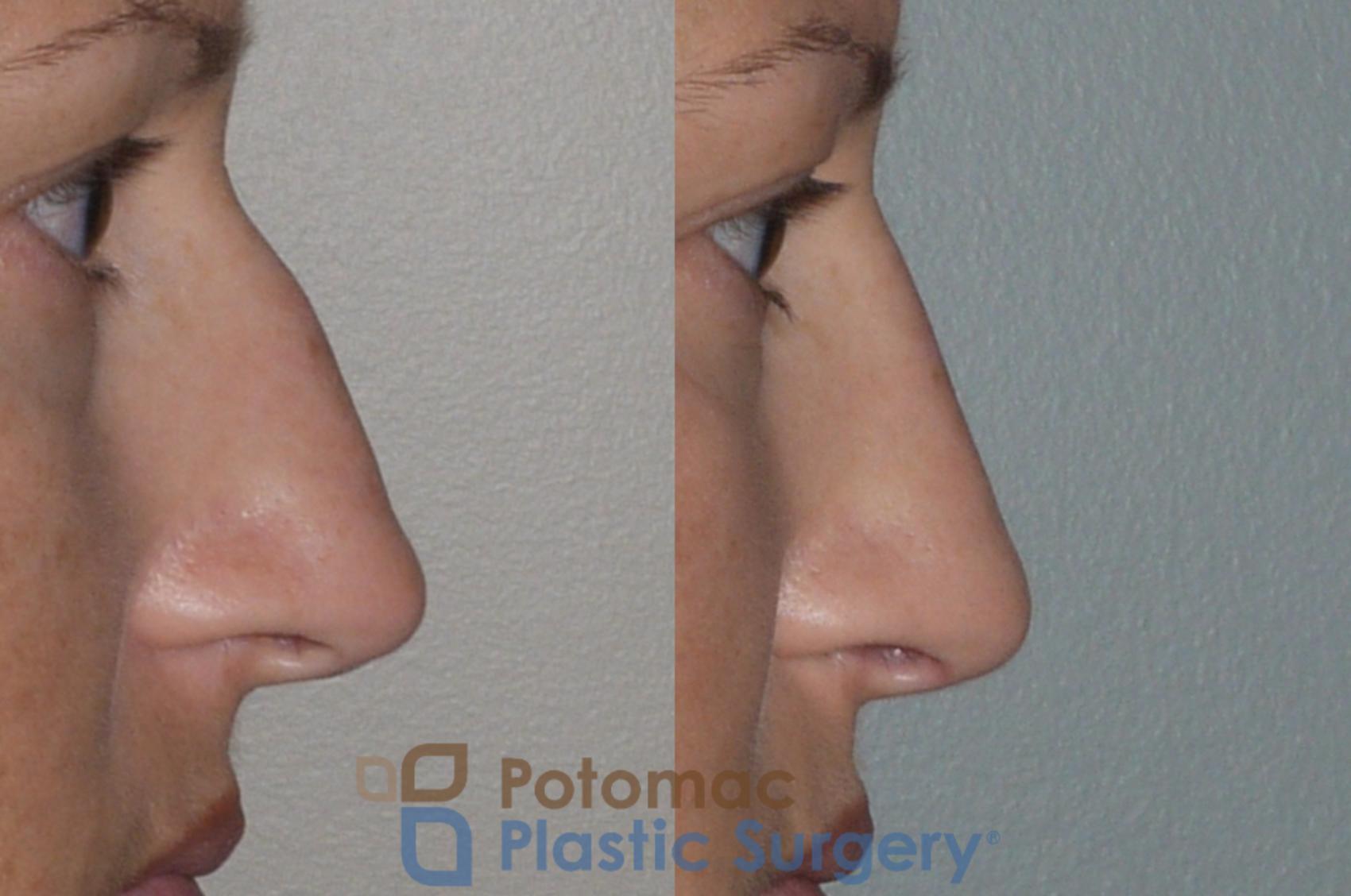 Before & After Rhinoplasty - Medical Case 112 Right Side View in Washington, DC