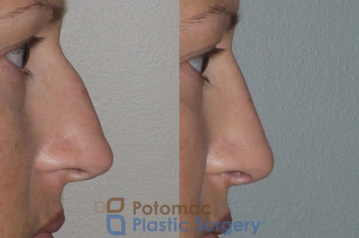 Before & After Rhinoplasty - Cosmetic Case 112 Right Side View in Washington DC & Arlington , DC