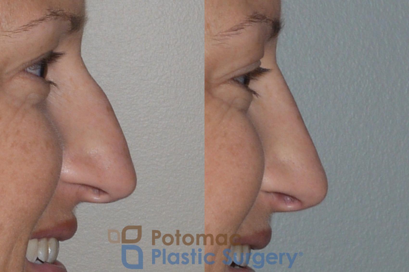 Before & After Rhinoplasty - Medical Case 112 Right Side View #2 View in Washington, DC