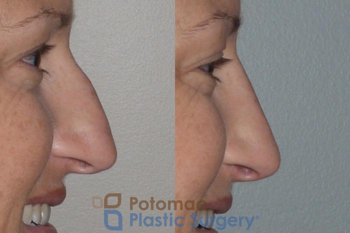 Before & After Rhinoplasty - Cosmetic Case 112 Right Side View #2 View in Washington DC & Arlington , DC