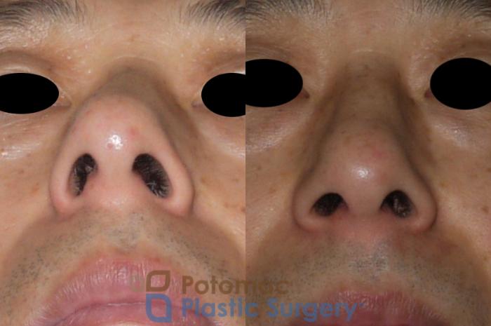 Before & After Rhinoplasty - Medical Case 115 Bottom View in Washington DC & Arlington , DC