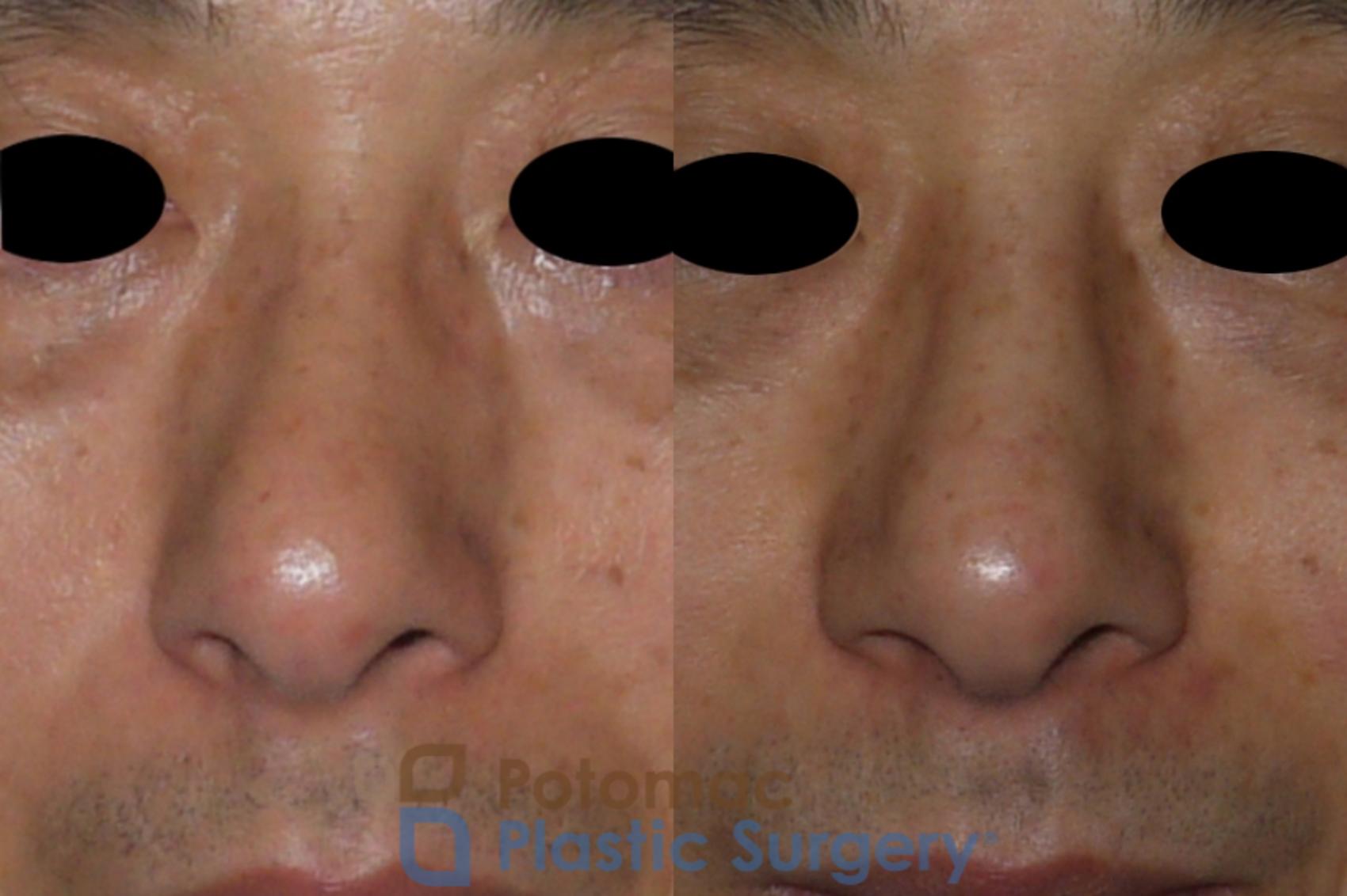 Before & After Rhinoplasty - Cosmetic Case 115 Front View in Washington DC & Arlington , DC