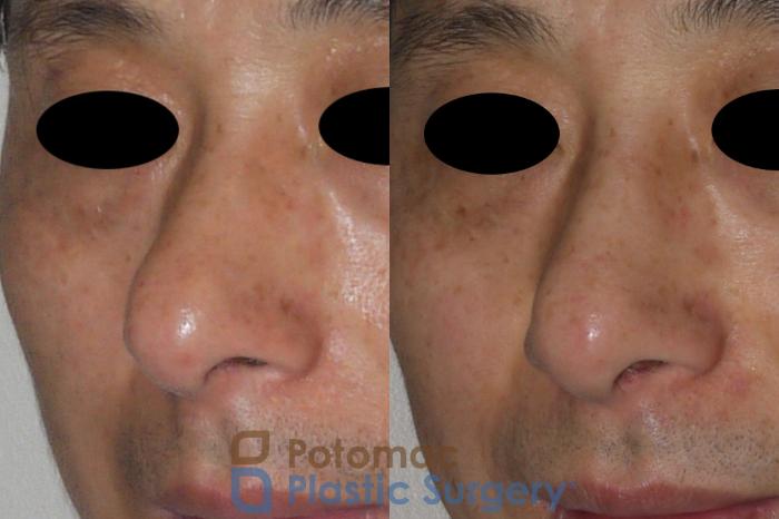 Before & After Rhinoplasty - Cosmetic Case 115 Left Oblique View in Washington DC & Arlington , DC