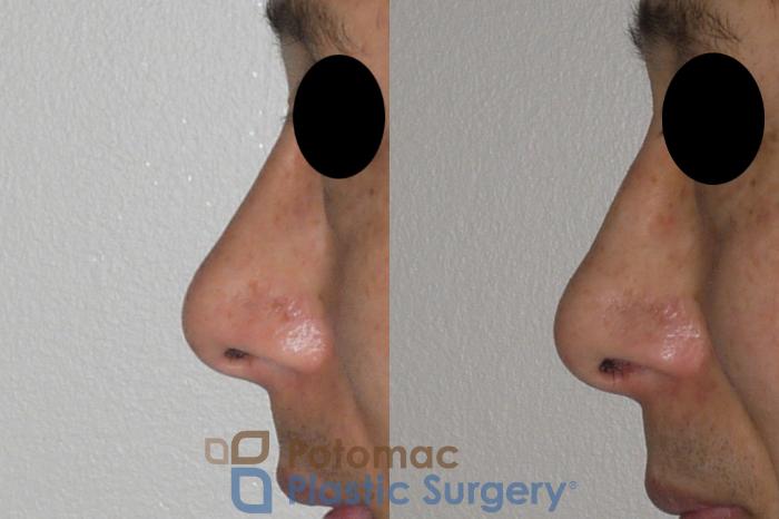 Before & After Rhinoplasty - Medical Case 115 Left Side View in Washington DC & Arlington , DC
